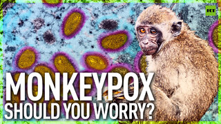 Monkeypox: Should You Worry?